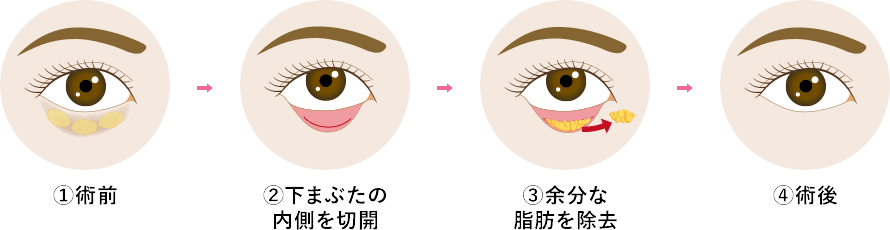 脱脂