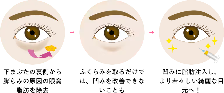 脱脂 + 脂肪注入