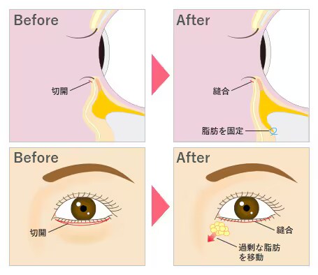 切開ハムラ法