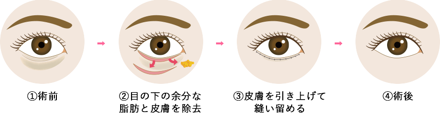 アイバックリムーブ法