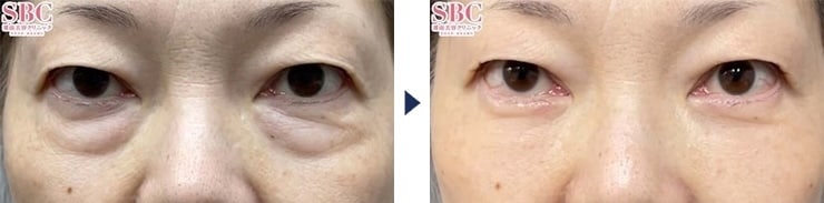 本田賢治医師のクマ取り症例