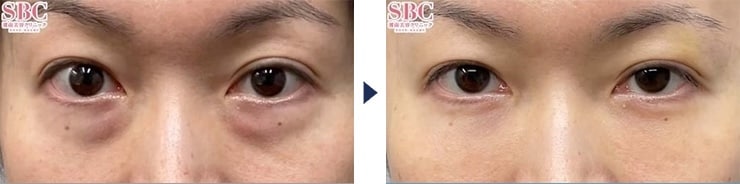 本田賢治医師のクマ取り症例