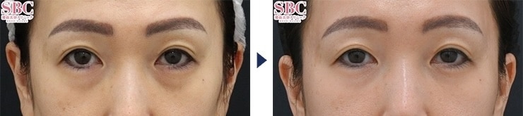 名倉医師のクマ取り症例