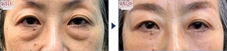 髙橋医師のクマ取り症例