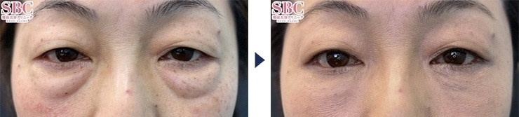 髙橋医師のクマ取り症例