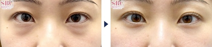 山下医師のクマ取り症例