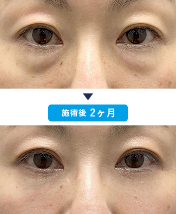山下昭悟医師のクマ取り症例