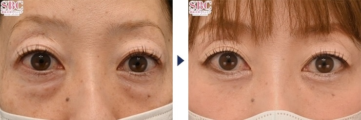 大野医師のクマ取り症例