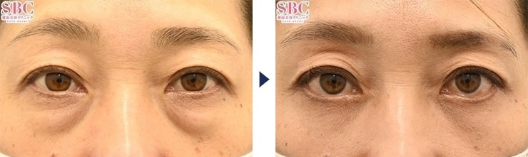 大野医師のクマ取り症例