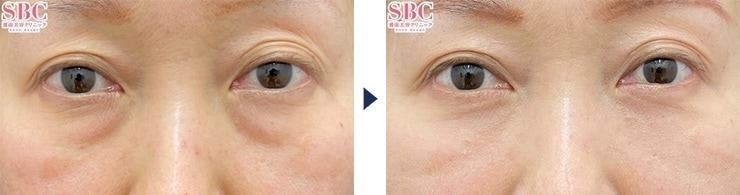 檜山医師のクマ取り症例