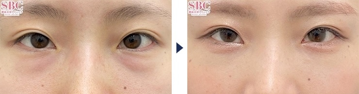 檜山医師のクマ取り症例