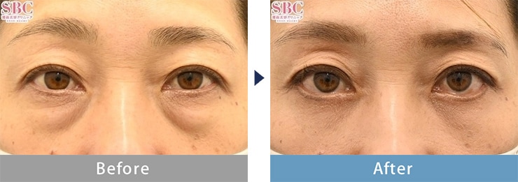 東京のクマ取り名医の症例写真6