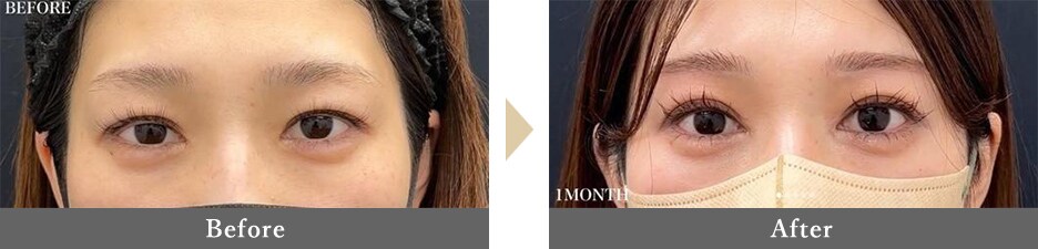 眉下切開×目頭切開の症例写真 Before After 1ヵ月後