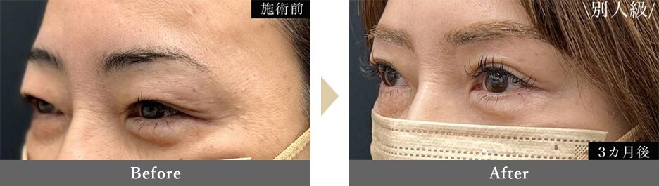 眉下切開（眉下リフト）、眼輪筋弁リフトの症例写真 Before After 3ヵ月後