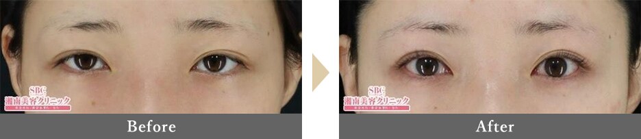 眉下切開（眉下リフト）、ROOF切除、MD式切開法の症例写真 Before After 7ヵ月後