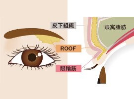 自然癒着セット（まぶたの脂肪取り）