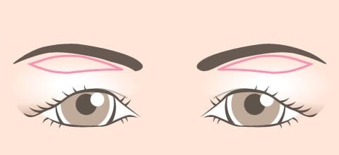 皮膚切除をデザイン