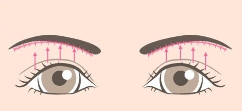眉下ラインに沿って縫合
