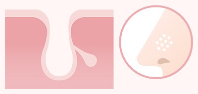 毛穴トラブルの種類と原因開き毛穴(すり鉢毛穴)