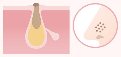 毛穴詰まりの色素沈着でできる黒ずみ毛穴