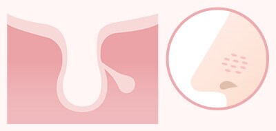 肌のハリが低下してできるたるみ毛穴