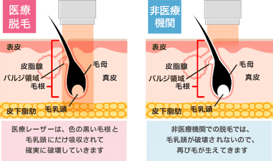 効果がある髭脱毛とは 費用は 方法は 基礎知識を徹底解説 工具男子新聞