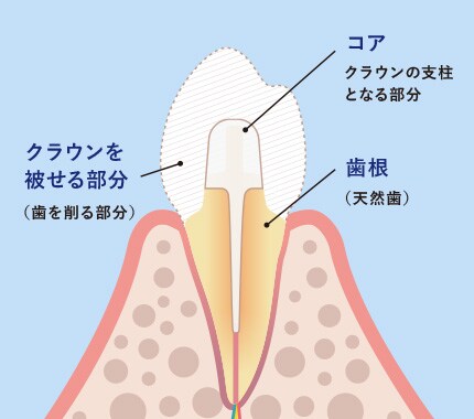 セラミック矯正
