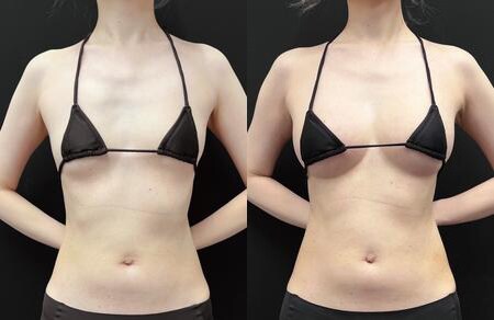豊胸のベスト症例写真