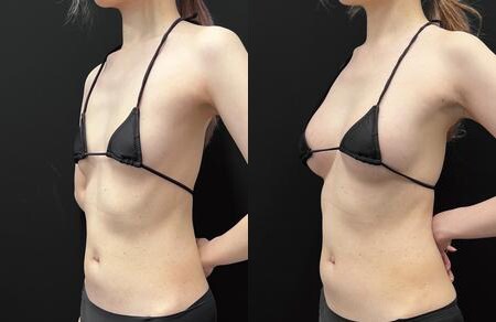 豊胸のベスト症例写真