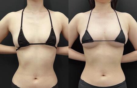 豊胸のベスト症例写真