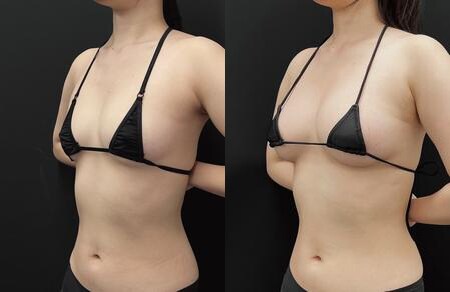 豊胸のベスト症例写真