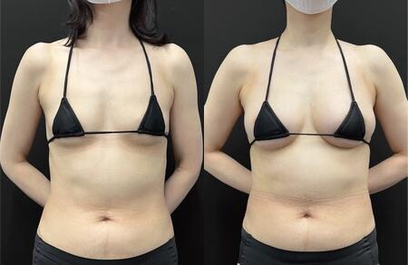 豊胸のベスト症例写真