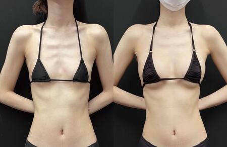 豊胸のベスト症例写真