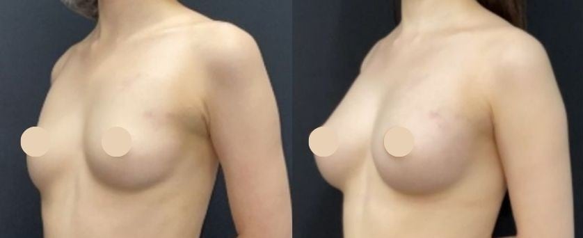 豊胸のベスト症例写真