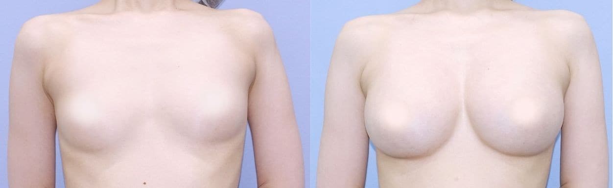 豊胸のベスト症例写真