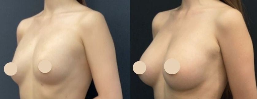 豊胸のベスト症例写真