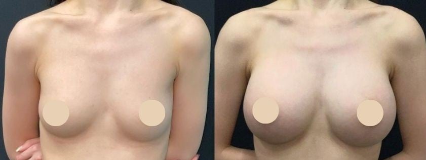 豊胸のベスト症例写真