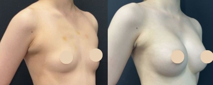 豊胸のベスト症例写真