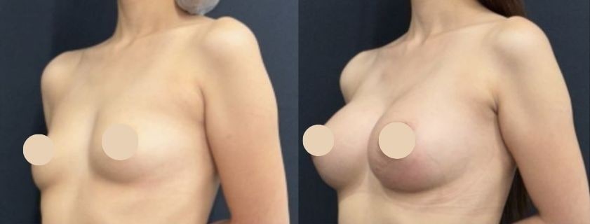 豊胸のベスト症例写真