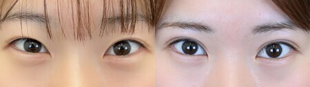 二重切開法のベスト症例写真
