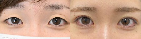 二重切開法のベスト症例写真