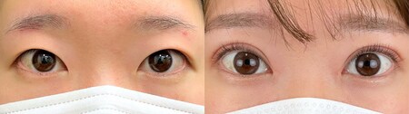 二重切開法のベスト症例写真