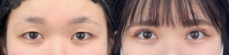 二重切開法のベスト症例写真