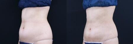 脂肪吸引のベスト症例写真