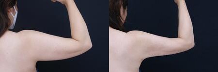 脂肪吸引のベスト症例写真