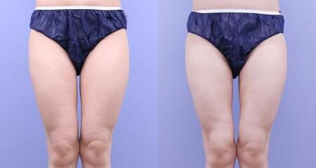 脂肪吸引のベスト症例写真