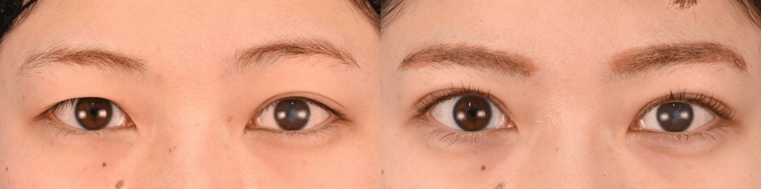 鼻整形のベスト症例写真