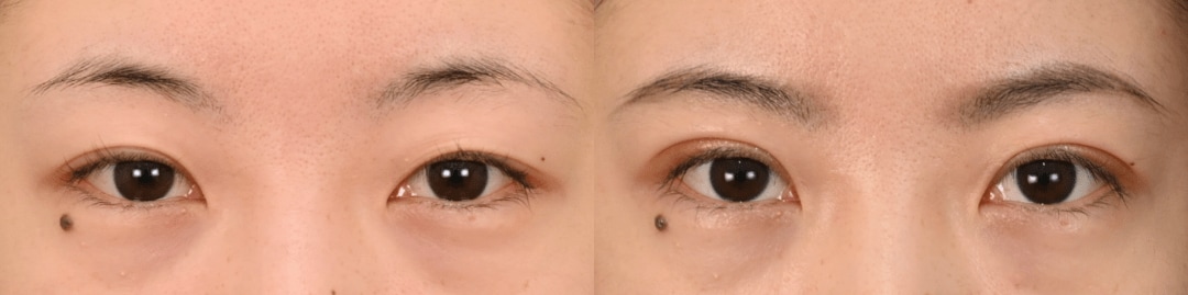 鼻整形のベスト症例写真