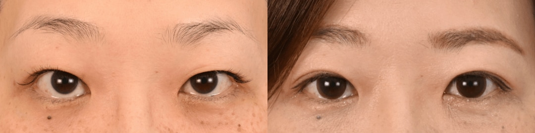 鼻整形のベスト症例写真