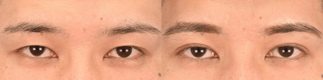 鼻整形のベスト症例写真